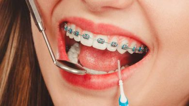 Achieving a Radiant Smile with Carle Place Braces: A Comprehensive Guide