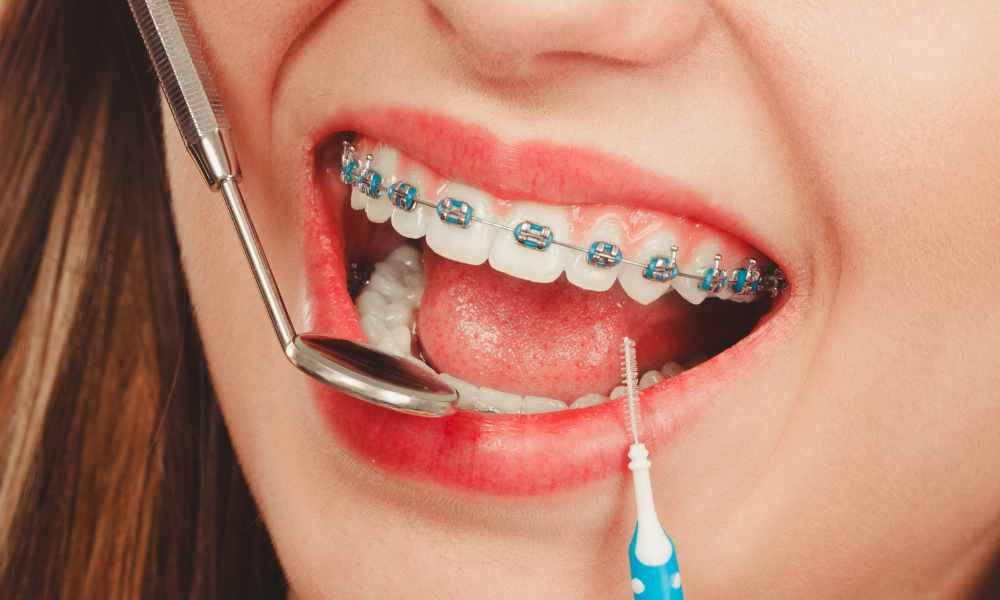 Achieving a Radiant Smile with Carle Place Braces: A Comprehensive Guide