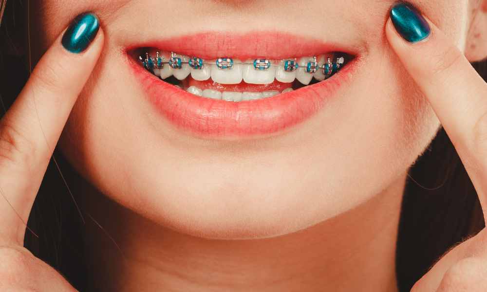 Oyster Bay Braces: Embracing the Future of Orthodontic Care