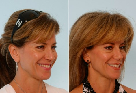 Whose Expertise Sets Queen Aesthetics Apart for Botox Injections in Houston