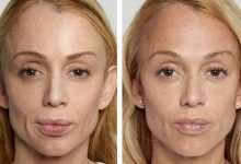 What Are the Benefits of Sculptra in Torrance