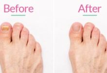 Where to Get the Best Laser Toenail Fungus Care