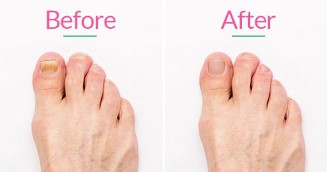 Where to Get the Best Laser Toenail Fungus Care