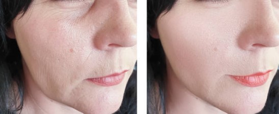 What Can You Expect Before and After Kybella Results