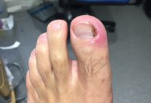 What Can You Expect During Toenail Removal Healing Stages