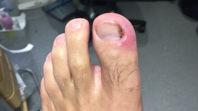 What Can You Expect During Toenail Removal Healing Stages