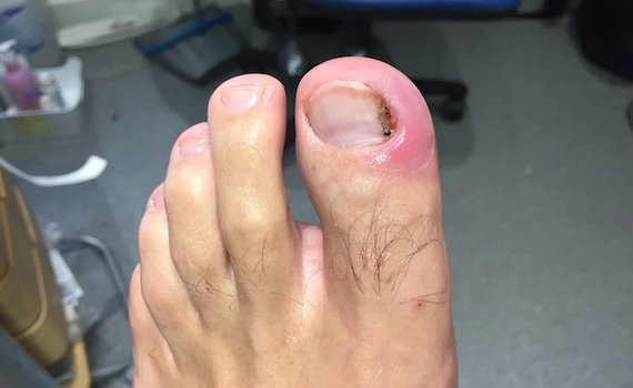 What Can You Expect During Toenail Removal Healing Stages