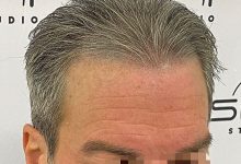 Scalp Micropigmentation: Confidence Restored