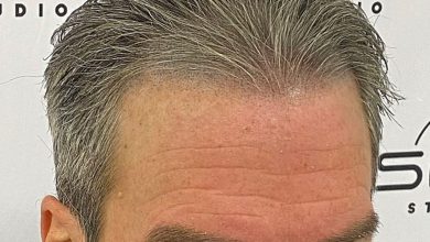 Scalp Micropigmentation: Confidence Restored