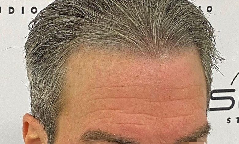 Scalp Micropigmentation: Confidence Restored